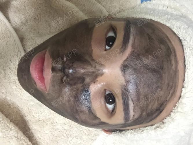 黑脸娃娃祛痘印效果真的好吗？-图1