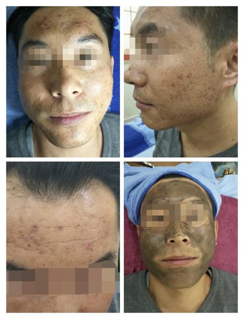 黑脸娃娃祛痘印效果真的好吗？-图2