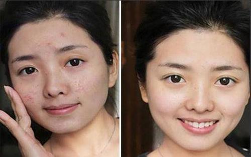 黑脸娃娃祛痘印效果真的好吗？-图3