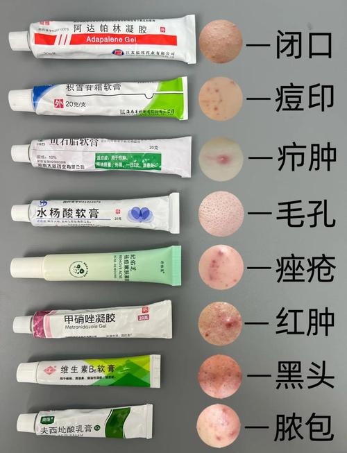 闭合性痘痘祛痘产品，哪种最有效？-图1
