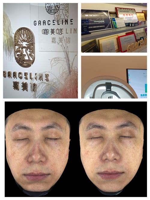 祛痘印选激光还是光子嫩肤？-图2