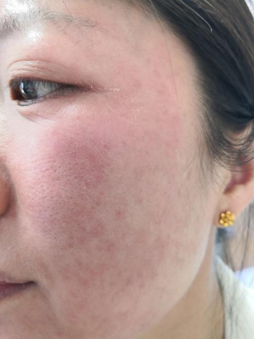 护肤品过敏症状有哪些？-图1