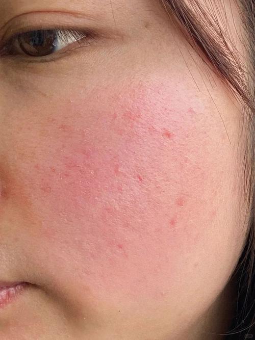 护肤品过敏症状有哪些？-图3