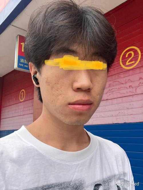 激光祛痘坑后多久能恢复如初？-图3
