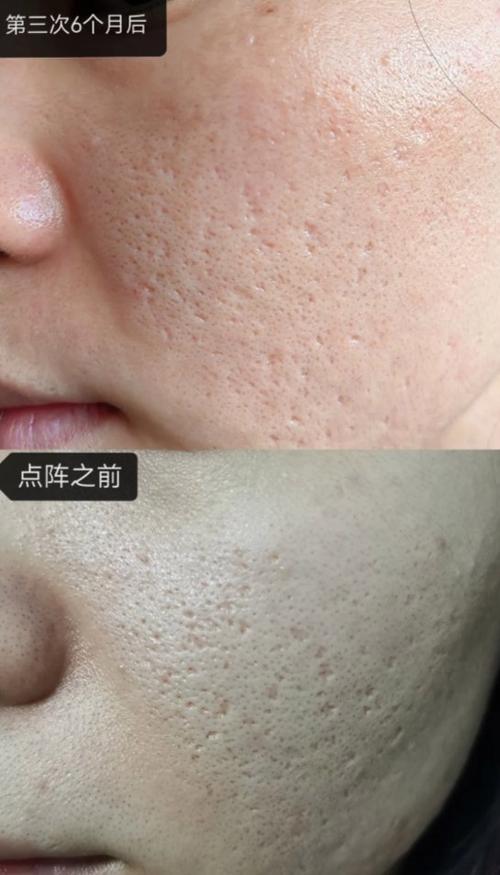 激光祛痘坑后多久能恢复如初？-图1