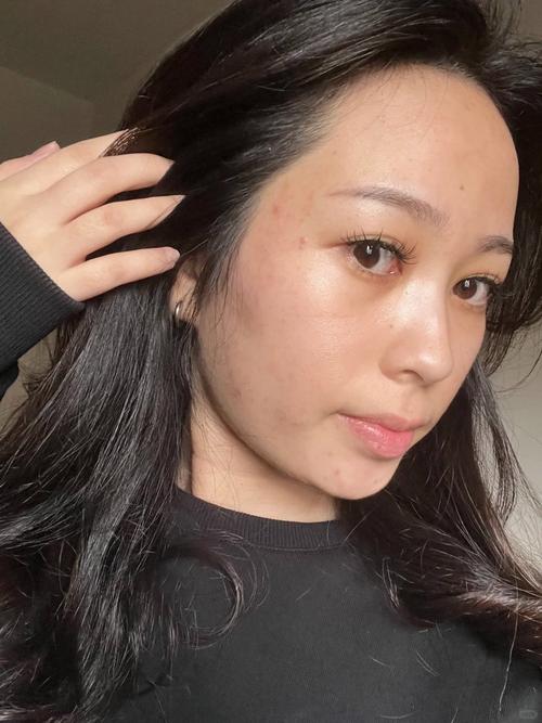 果酸祛痘后多久能化妆？-图2