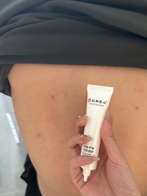 背部磨砂祛痘选什么产品好？-图2