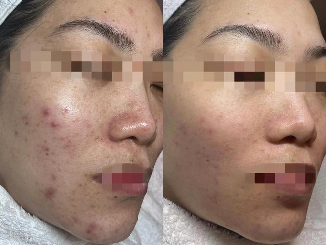 痘痘总是反复 颜值祛痘-图2