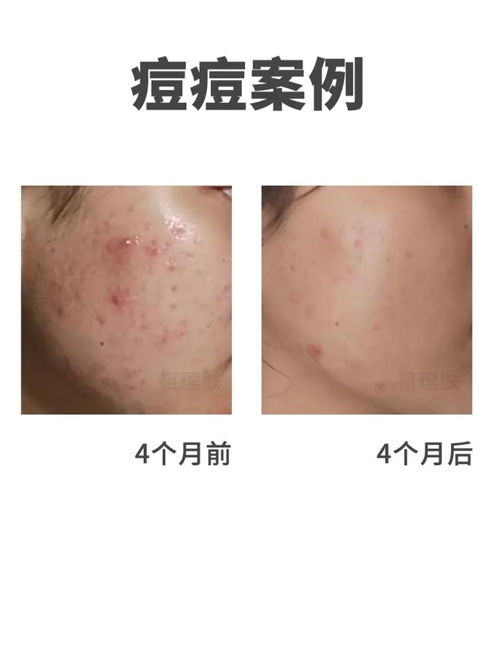 痘痘总是反复 颜值祛痘-图3
