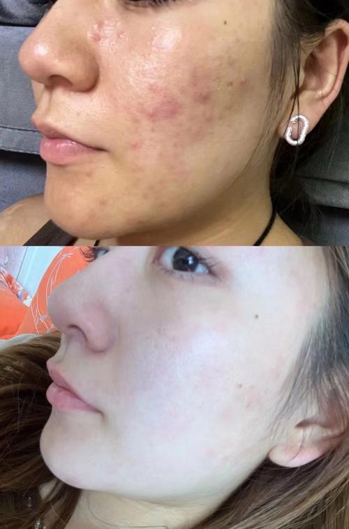 痘痘总是反复 颜值祛痘-图1