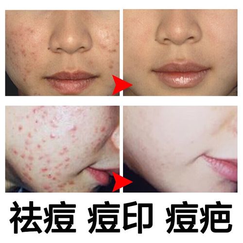 瓷肌祛痘套装正确使用步骤是？-图1