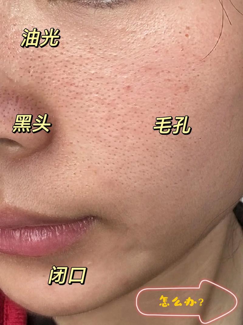 毛孔大黑头困扰，选什么护肤品？-图1