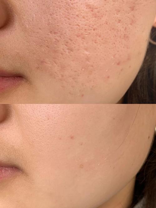 美容院祛痘真的会留痘印吗？-图1