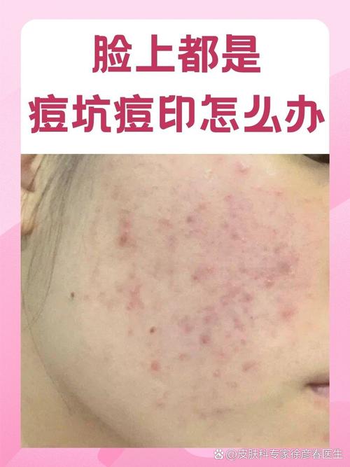 美容院祛痘真的会留痘印吗？-图3