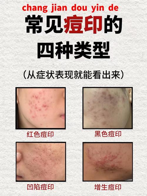 祛红血丝和祛痘坑，先处理哪个更有效？-图2