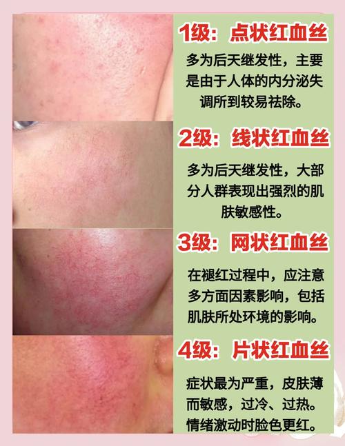 祛红血丝和祛痘坑，先处理哪个更有效？-图1