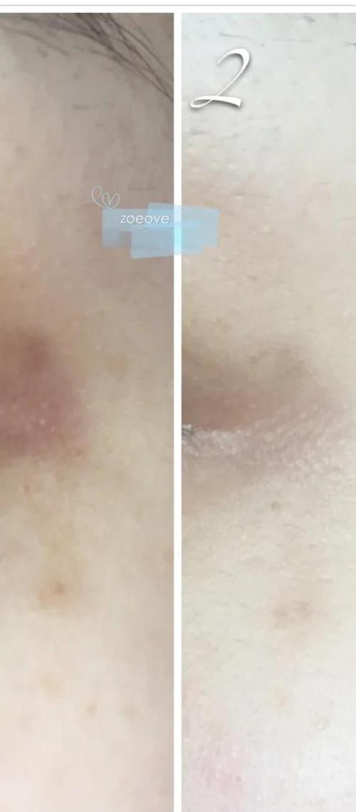 pola局部精华祛痘印真的有效吗？-图1