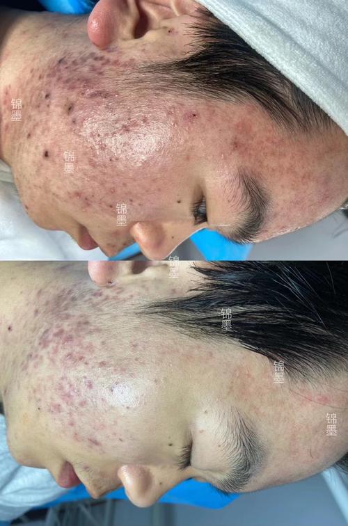 脸上长痘到底能不能敷祛痘面膜？-图2