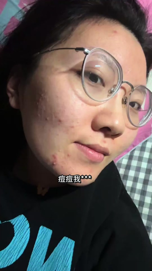 喝中药祛痘会先出痘多吗-图1