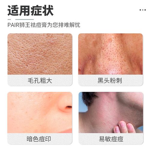 狮王祛痘膏 能去痘印吗-图3