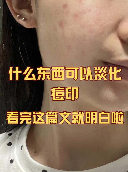 复合光能祛痘去痘印吗？-图3