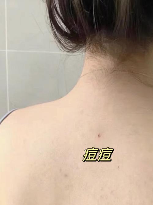 cosme大赏背部祛痘真的有效吗？-图1