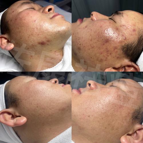 cosme大赏背部祛痘真的有效吗？-图3