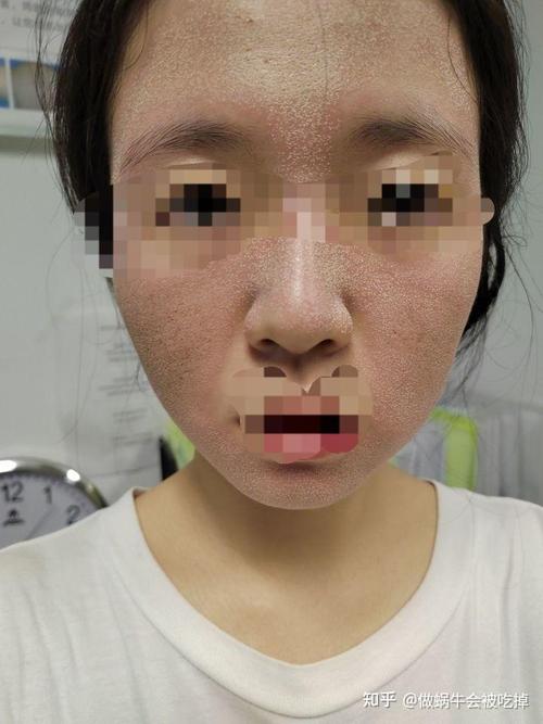 点阵激光 祛痘记录_-图3