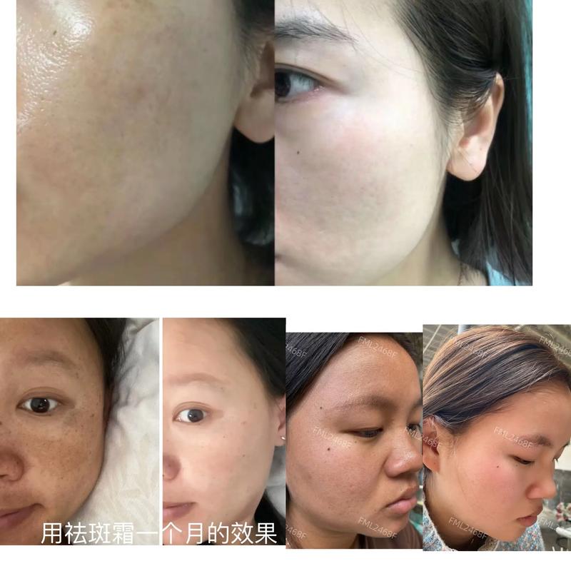 祛斑祛痘哪种方法最有效？-图3