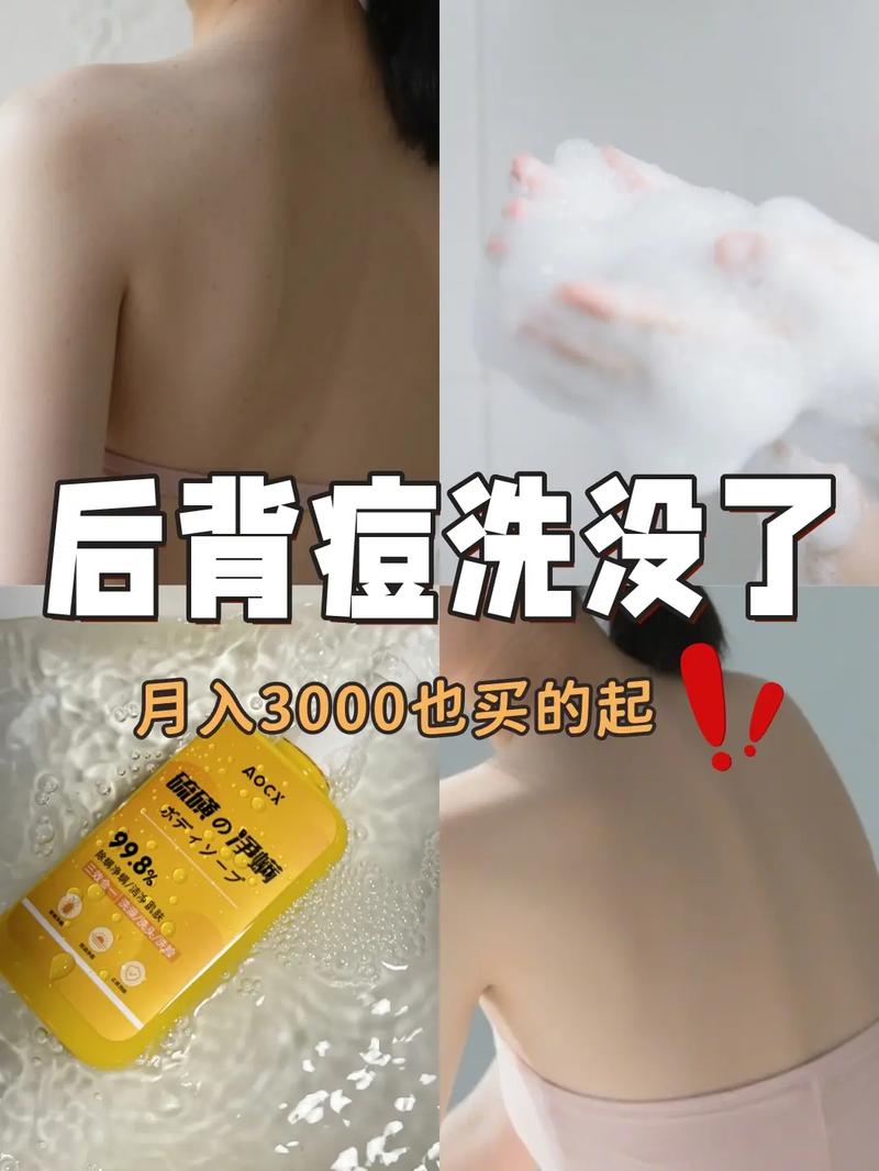 硫磺皂可以祛痘祛螨虫吗-图2