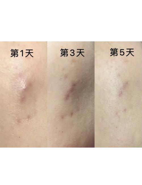 哪种护肤品祛痘印效果最好？-图3