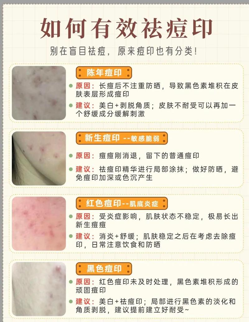 如何用简单的方法祛痘印-图2