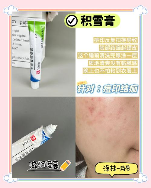 小林制药祛痘膏怎么用才有效?-图1 小林制药祛痘膏怎么用才有效?-图1