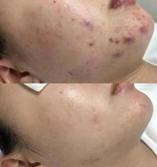 acne.org 祛痘-图2