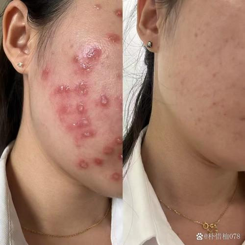 维生素e与珍珠粉祛痘印-图3