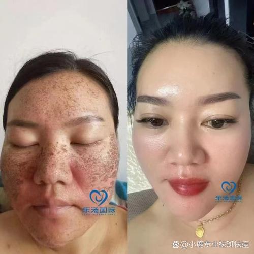 珍珠粉加维生素e祛痘印真的有效吗？-图3