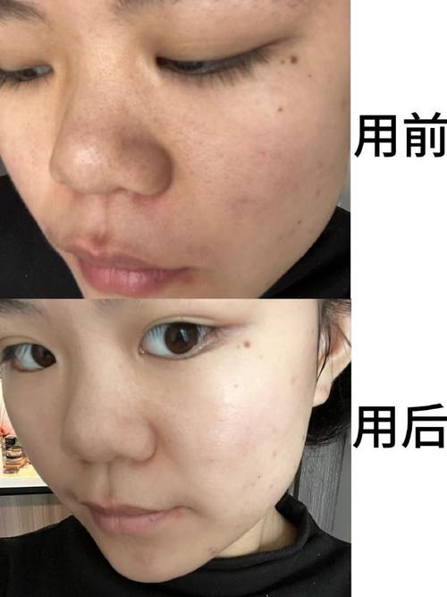 珍珠粉加维生素e祛痘印真的有效吗？-图1