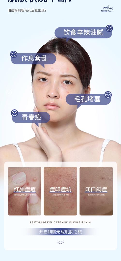 水杨酸祛痘多久能恢复？-图3