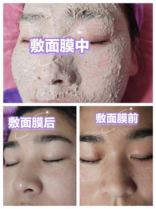 中药面膜能祛痘坑吗？-图3