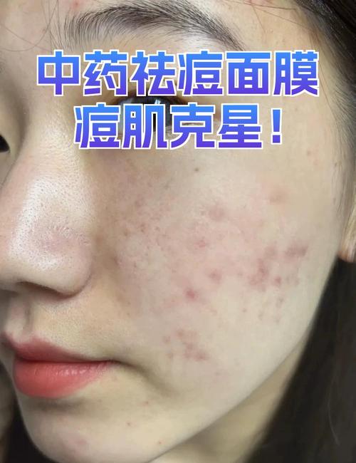 中药面膜能祛痘坑吗？-图1