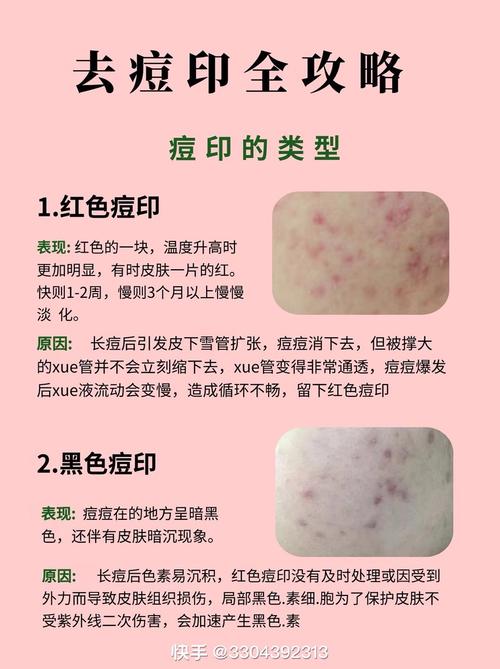 如何有效祛除红黑痘印？-图1