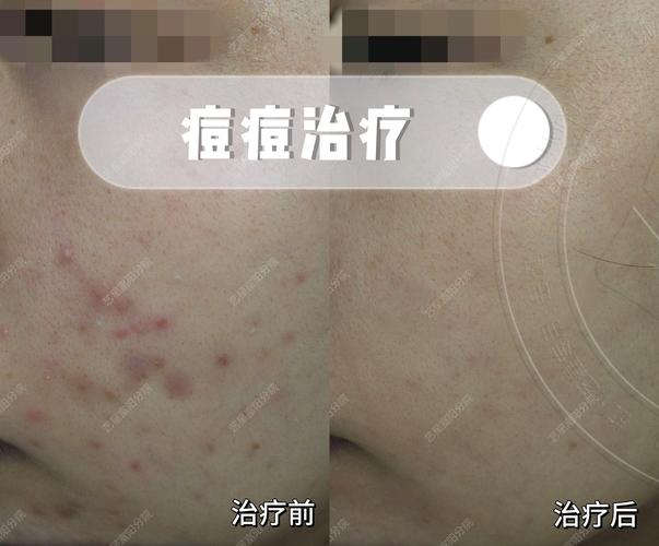 合肥艺星激光祛痘痕效果如何？-图2