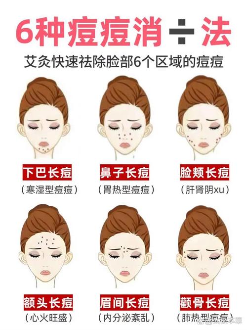 艾灸灰祛痘印怎么用才有效？-图1