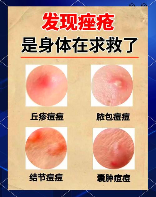 祛痘排毒到底排的是什么毒？-图3