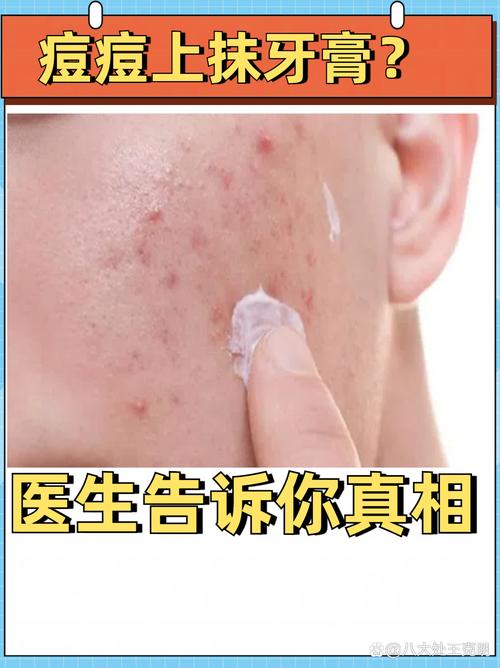 牙膏祛痘靠谱吗？这些注意事项要牢记！-图3