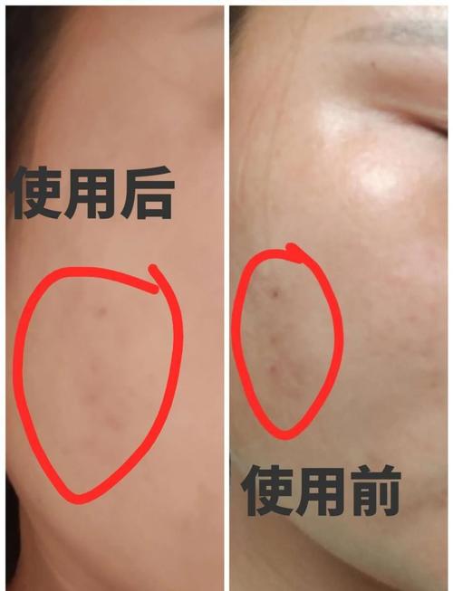 先保湿还是先涂祛痘膏？顺序有讲究吗？-图3