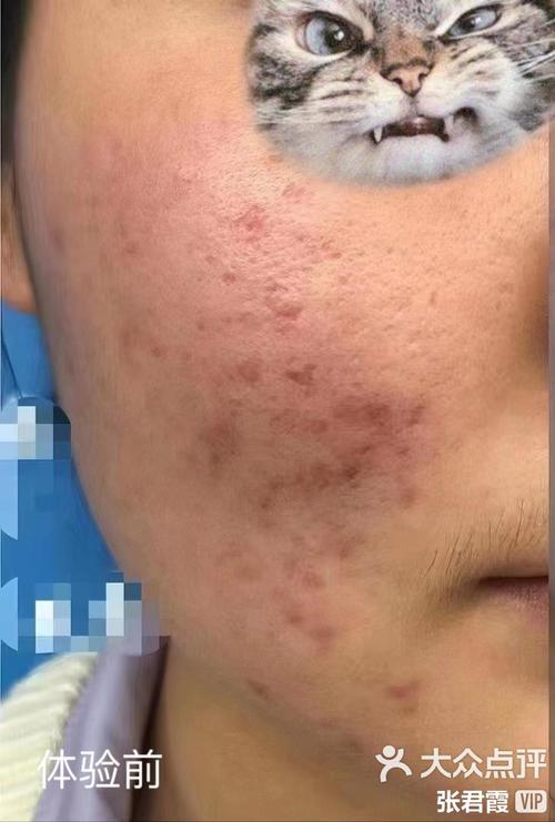 我的美丽日记祛痘效果到底如何？-图1