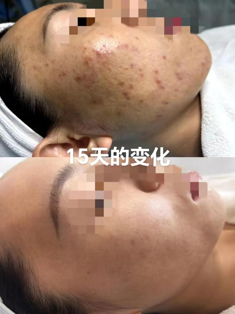 我的美丽日记祛痘效果到底如何？-图3