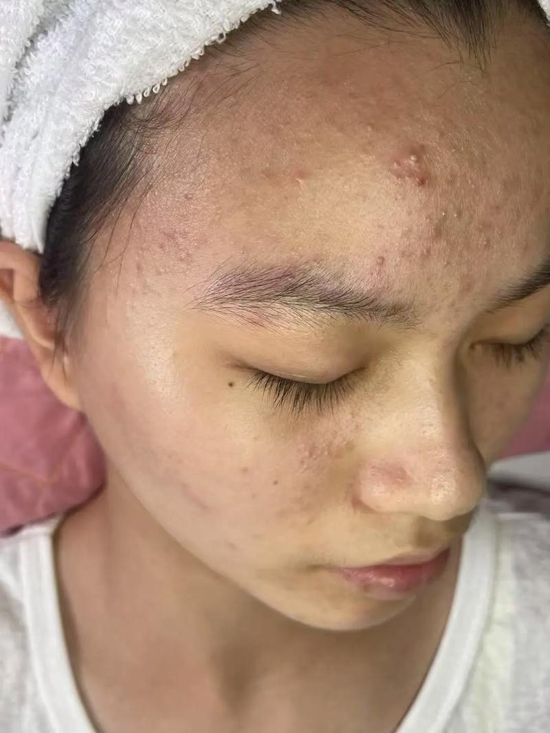 中药祛痘真的有效吗？-图3