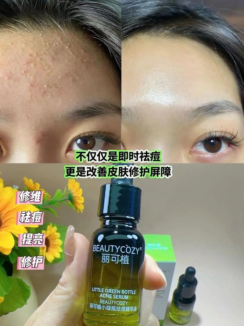 祛痘精华含激素吗？-图2